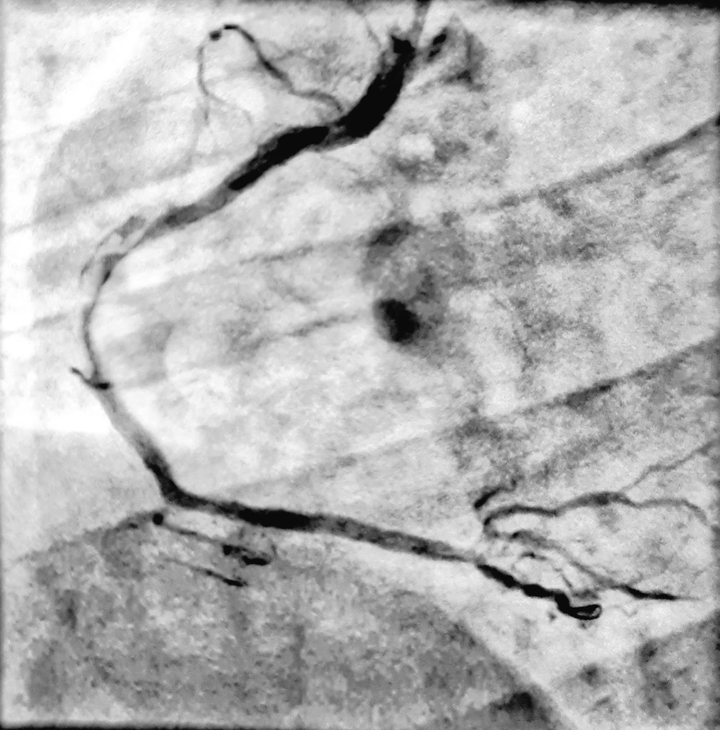HatimLawati's tweet image. Aspiration #thrombectomy in #STEMI can sometimes retrieve more than just the #Thrombus !! [clot + lipid debris] 

#Fellows2024 #EAPCI #Cardiology #CardioTwitter #ACCFIT 

@mirvatalasnag @AdilRiyami @AlkashkariWail @SACIS_KSA @APSIC6 @PCRonline @FBardooli @SCAI @crfheart