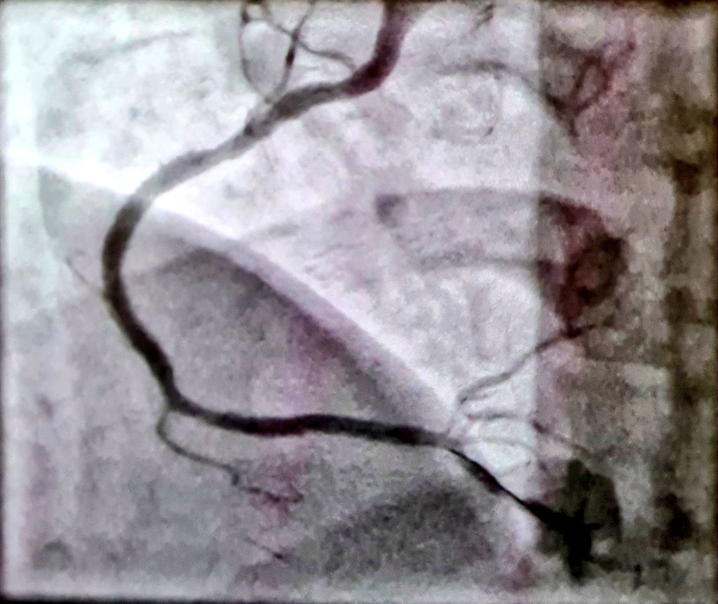 HatimLawati's tweet image. Aspiration #thrombectomy in #STEMI can sometimes retrieve more than just the #Thrombus !! [clot + lipid debris] 

#Fellows2024 #EAPCI #Cardiology #CardioTwitter #ACCFIT 

@mirvatalasnag @AdilRiyami @AlkashkariWail @SACIS_KSA @APSIC6 @PCRonline @FBardooli @SCAI @crfheart