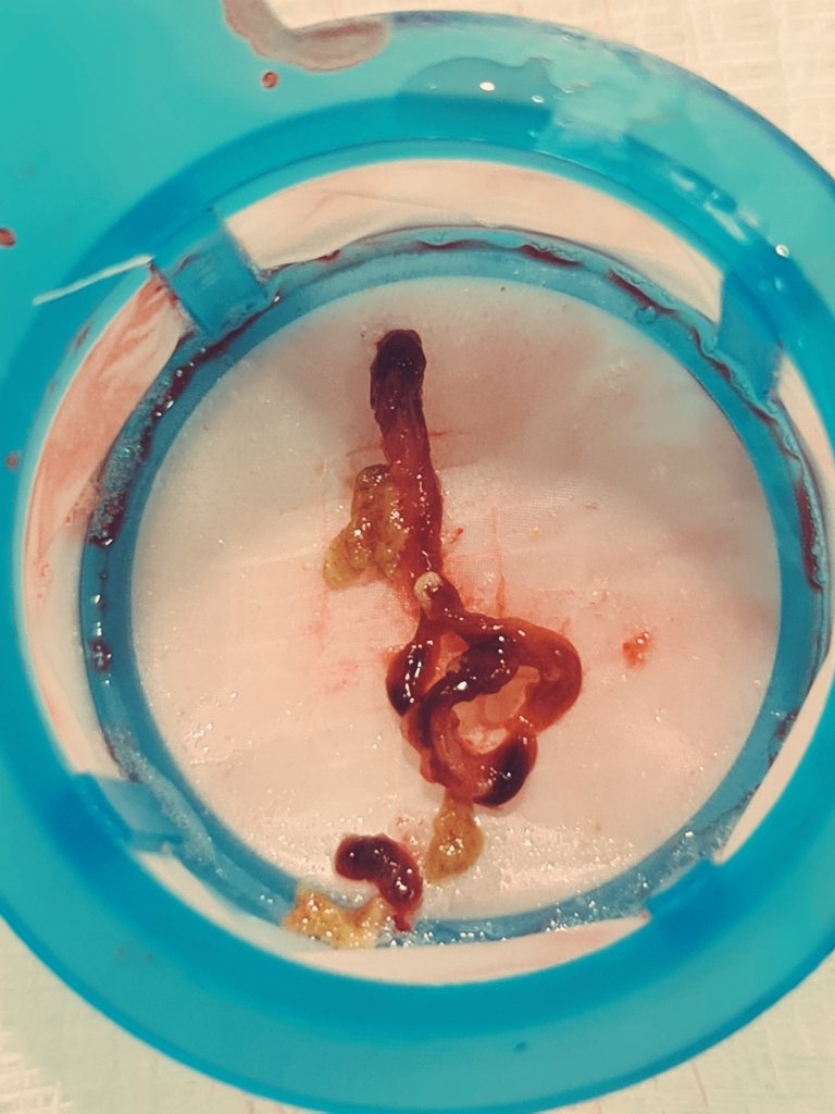 HatimLawati's tweet image. Aspiration #thrombectomy in #STEMI can sometimes retrieve more than just the #Thrombus !! [clot + lipid debris] 

#Fellows2024 #EAPCI #Cardiology #CardioTwitter #ACCFIT 

@mirvatalasnag @AdilRiyami @AlkashkariWail @SACIS_KSA @APSIC6 @PCRonline @FBardooli @SCAI @crfheart