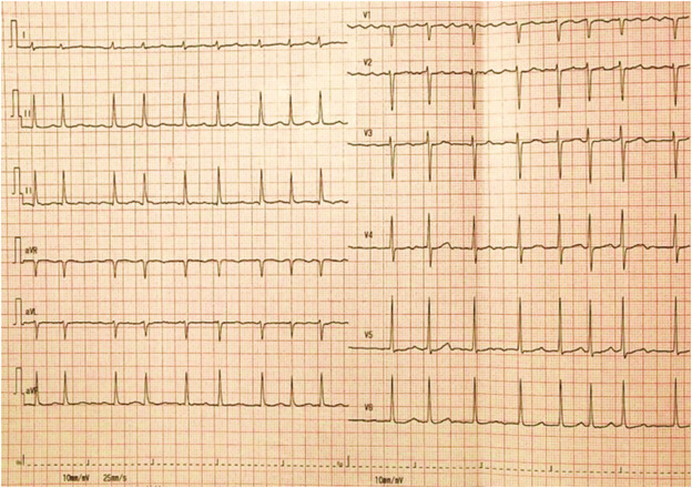 Case report: A 56-year-old woman presenting with torsades de pointes and cardiac arrest associated with levosimendan administration and underlying congenital long QT syndrome type 1 dlvr.it/T5V6LZ