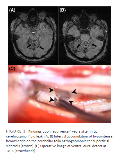 Open Access: Case of superficial siderosis after remission of #IntracranialHypotension symptoms w epidural patching highlights the importance of post-treatment monitoring in patients w ventral spinal #CSFleaks & #SIH @DrIanCarroll & @WouterSchievink …adachejournal.onlinelibrary.wiley.com/doi/full/10.11…