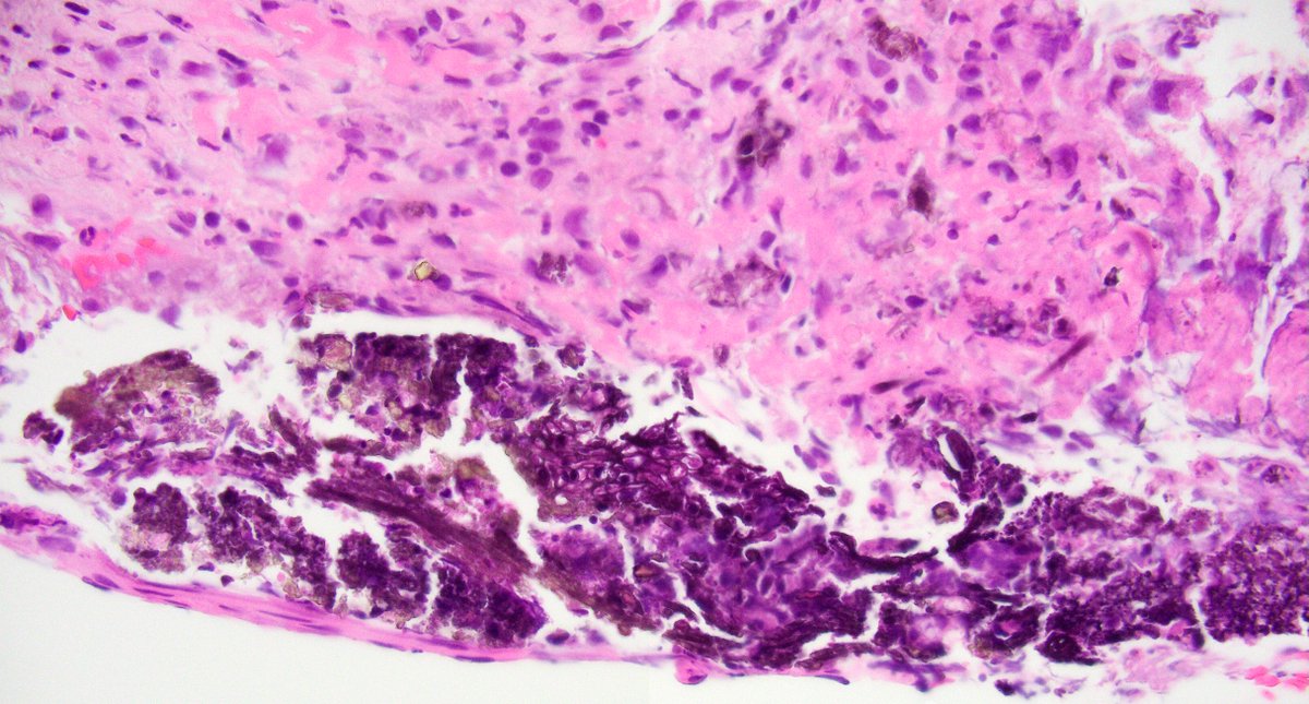 Recognize iron pill esophagitis and carditis in biopsies by brown to black color on H&E with or without ulceration. When in doubt, iron stain is useful. #GIpath