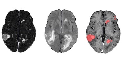 Publicly available dataset of 560 multimodal brain MRIs in 412 patients undergoing gamma knife #radiosurgery doi.org/10.1148/ryai.2… @RadRudie @UCSFimaging @UCSDImaging #BrainMets #NeuroRad #MachineLearning