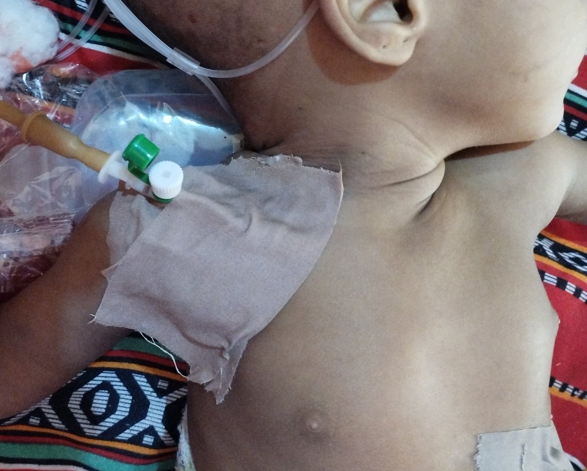 Aliyu_Hydaer's tweet photo. 8 months old child
Parents have no money for central line, size 18 cannula successfully improvised as subclavian central line👍 https://t.co/ugCPDRYo86