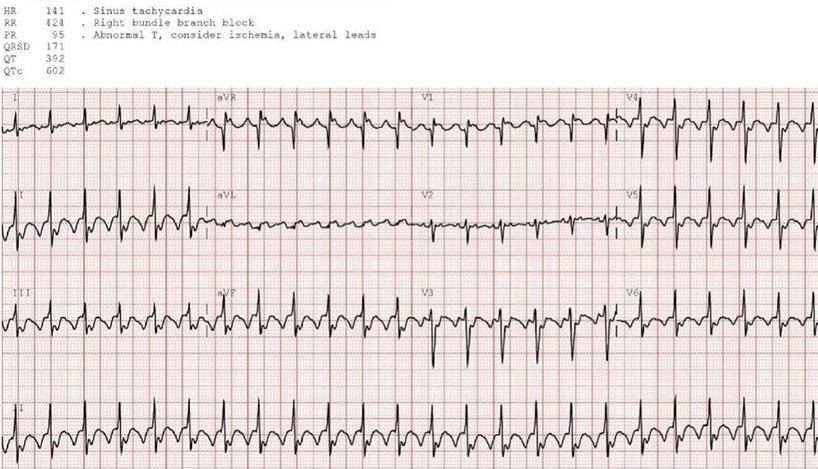 55 year old with vomiting. Do you agree with the computer interpretation? 
#ECG #EKG #FOAMed #MedEd #medstudent #resident #Paramedic #Cardiology #EmergencyMedicine