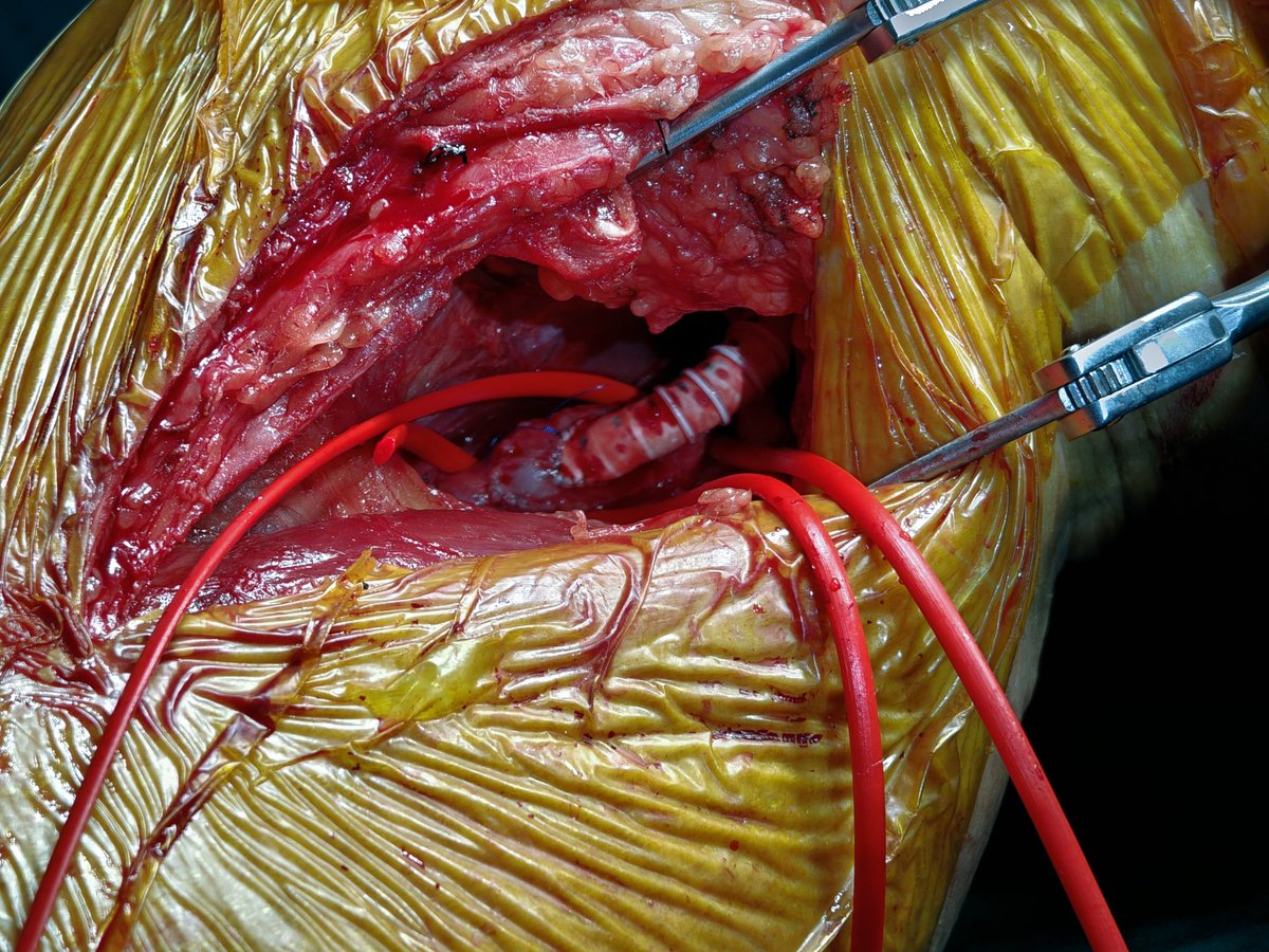 yuejianing's tweet photo. A #BESTCLI cohort II pt. R5 ischemia after multiple endos for FP ISR, single per runoff, GSV unavailable, cardiomyopathy. So, easy mode in bypass surgery: HePTFE+DVP #CLTI #CLTIFighter https://t.co/u9F61iSjkG
