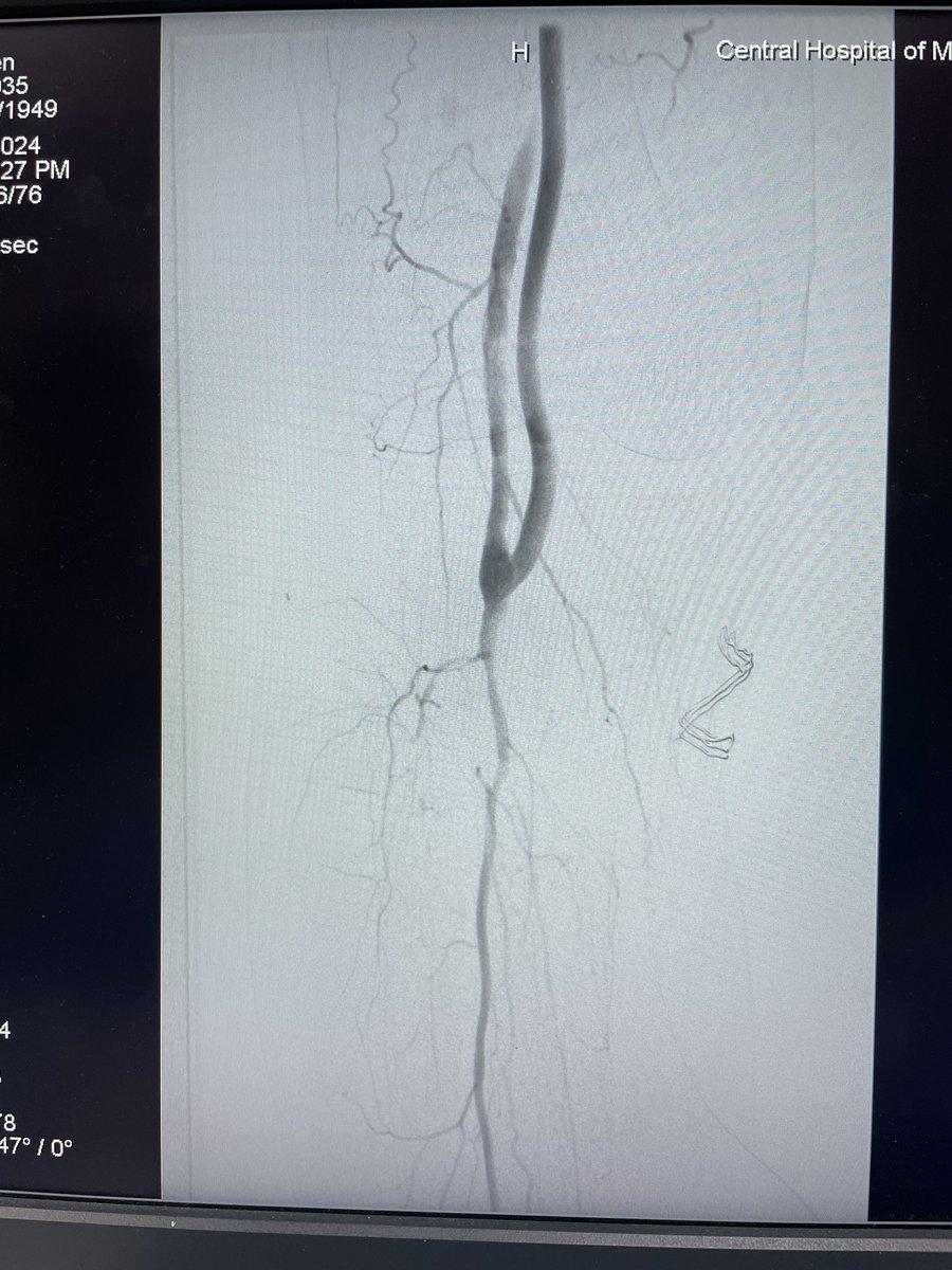 yuejianing's tweet photo. A #BESTCLI cohort II pt. R5 ischemia after multiple endos for FP ISR, single per runoff, GSV unavailable, cardiomyopathy. So, easy mode in bypass surgery: HePTFE+DVP #CLTI #CLTIFighter https://t.co/u9F61iSjkG