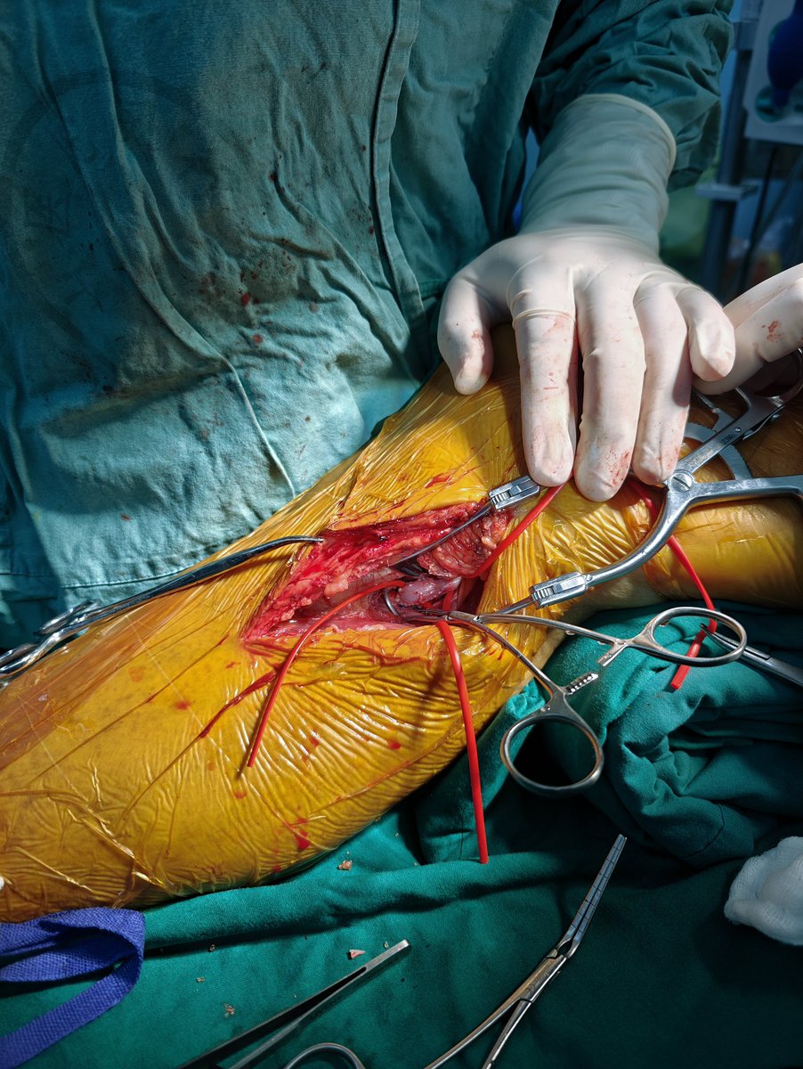 yuejianing's tweet photo. A #BESTCLI cohort II pt. R5 ischemia after multiple endos for FP ISR, single per runoff, GSV unavailable, cardiomyopathy. So, easy mode in bypass surgery: HePTFE+DVP #CLTI #CLTIFighter https://t.co/u9F61iSjkG