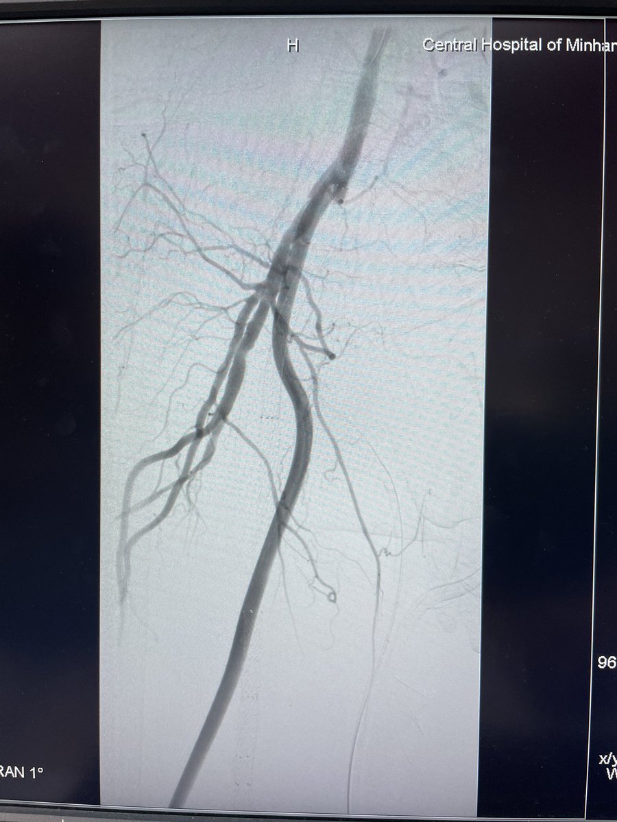 yuejianing's tweet photo. A #BESTCLI cohort II pt. R5 ischemia after multiple endos for FP ISR, single per runoff, GSV unavailable, cardiomyopathy. So, easy mode in bypass surgery: HePTFE+DVP #CLTI #CLTIFighter https://t.co/u9F61iSjkG