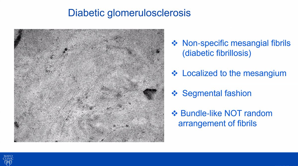 Diabetic fibrillosis is a morphologic mimic of fibrillary glomerulonephritis.  
There are ultrastructural differences, but also DNAJB9 immunostaining can be used to distinguish between the two.  
By @MPAlexanderMD at @GlomCon