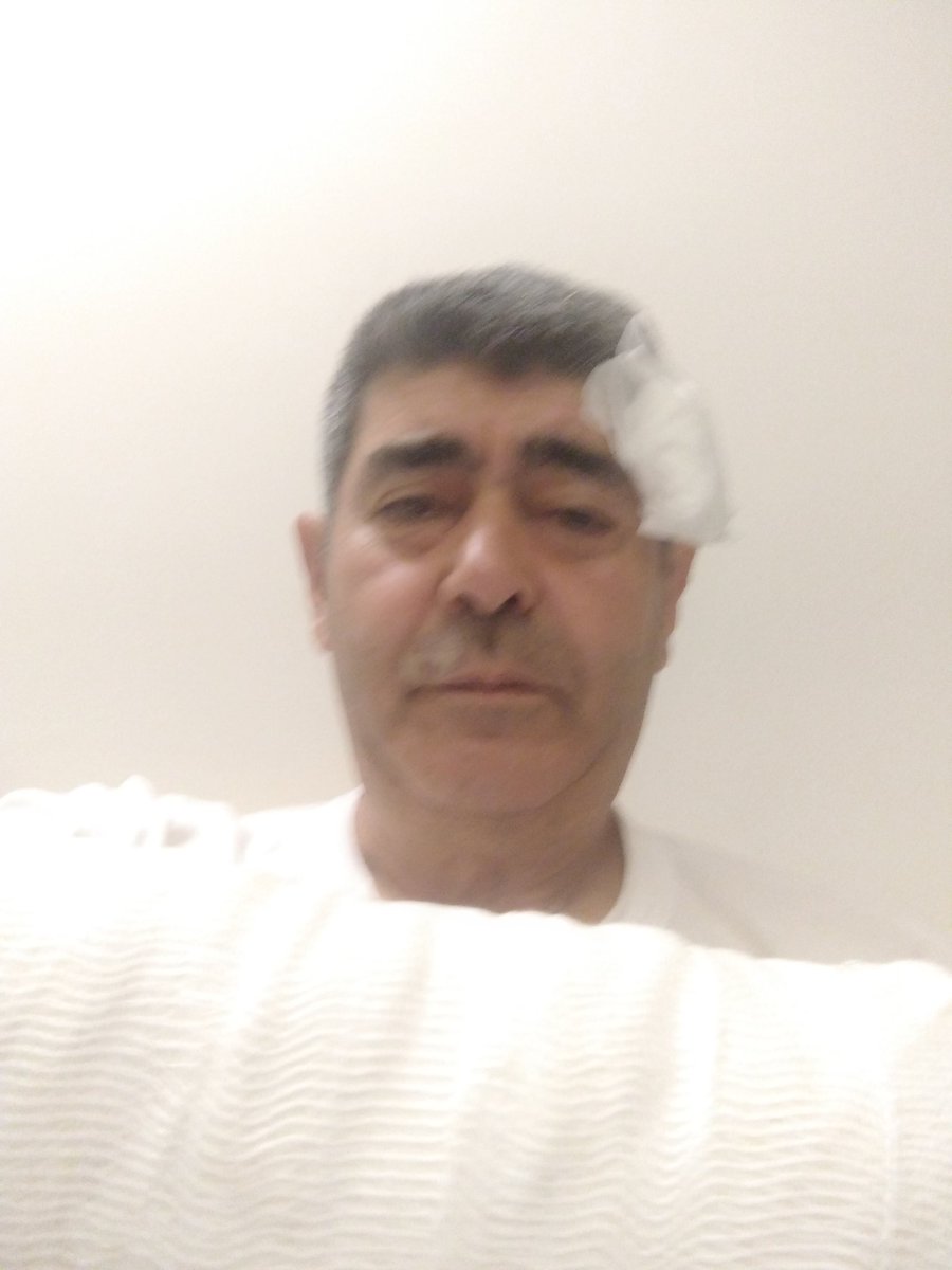 aksoy2835's tweet photo. Dün akşam Giresun içindeki bindigim dolmuşta kendimiz dışında bir yolcunun haklarını savunurken şoförün sinkaflı konuşmalarından cesaret alan dolmuş içindeki birkaç maganda tarafından darp edildik. Bir kol kırık göz üstünde ve kafatasında yarıklarla durumu atlattık. https://t.co/cewYBUS0kr