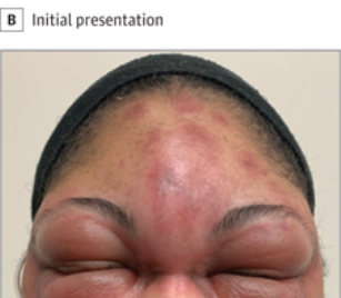 JAMADerm's tweet photo. This case report describes the clinical course of a 32-year-old woman with anti-synthetase syndrome presenting with angioedema-like panniculitis and subsequently cutaneous ulcers, synovitis, and fevers, found to have a clonal TCR-beta gene rearrangement. https://t.co/mXbNmmHjY0 https://t.co/KLI5uAJDc8