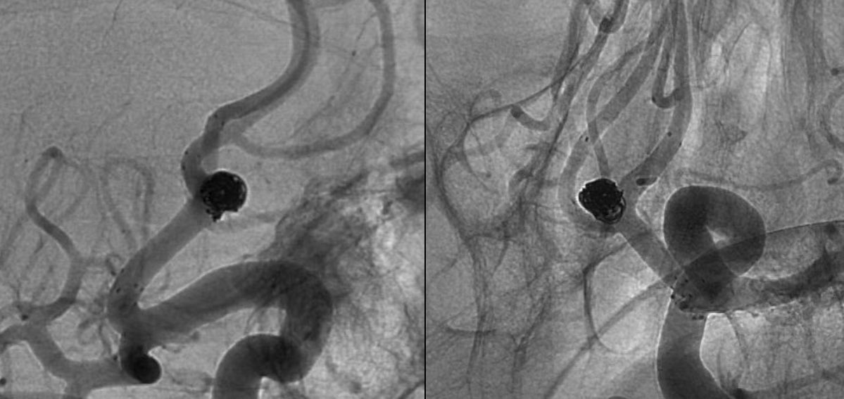 Y-configuration double-stent-assisted #coiling using two laser-cut open-cell #stents with #antithrombogenic HPC (#pEGASUS HPC Stent) for wide-neck #aneurysm in the anterior communicating artery (ACoA). @Sremollo , @IsaRCaamano , Rosa Garcia-Sort. pubmed.ncbi.nlm.nih.gov/28587530/