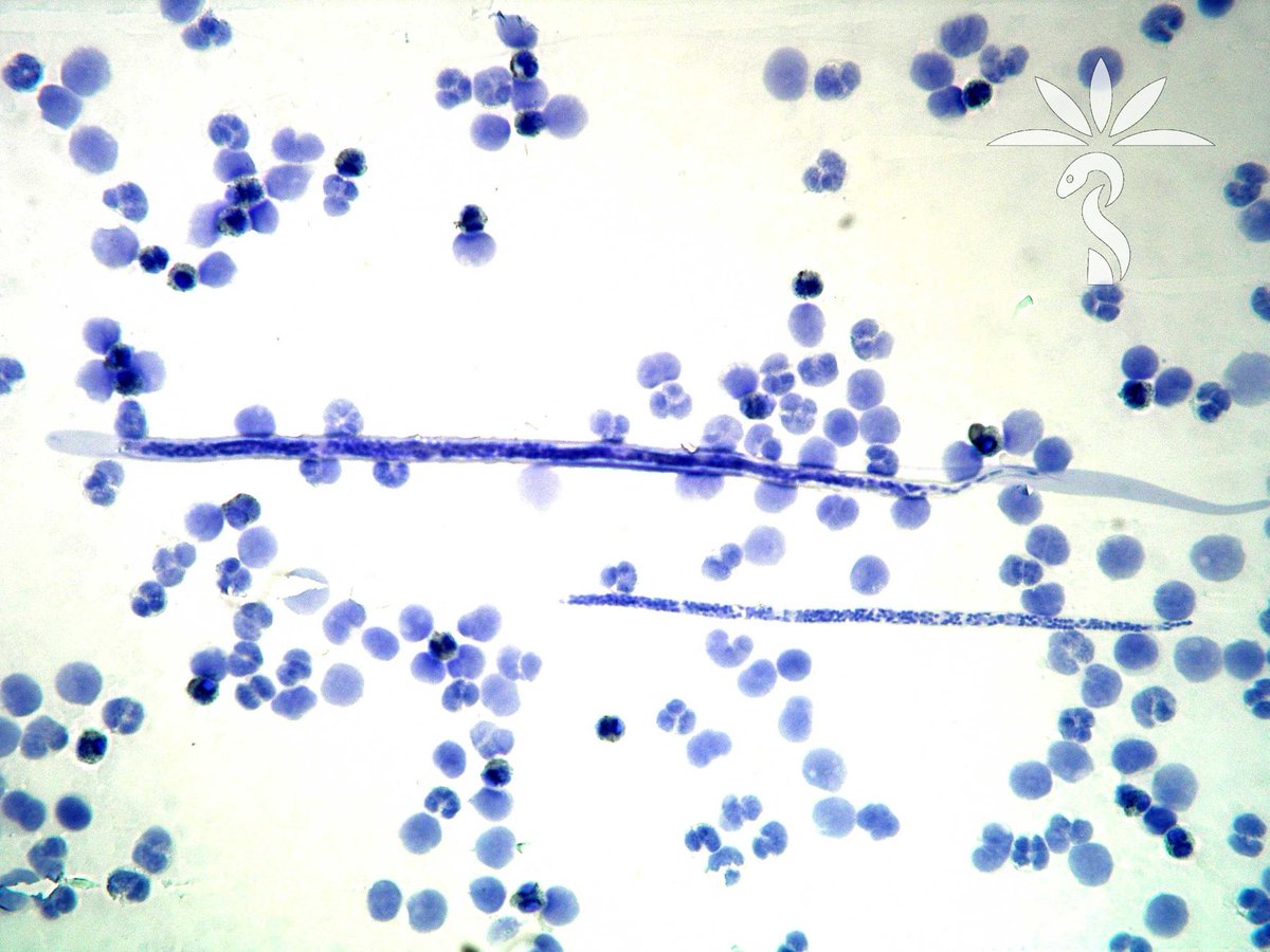 Here’s an amazing case of 2 different microfilariae species in blood from Idzi Potters and ⁦⁦@ITMantwerp⁩ . Can you tell which microfilariae are present? Patient is from Cameroon. Answer here: parasitewonders.blogspot.com/2024/04/answer…