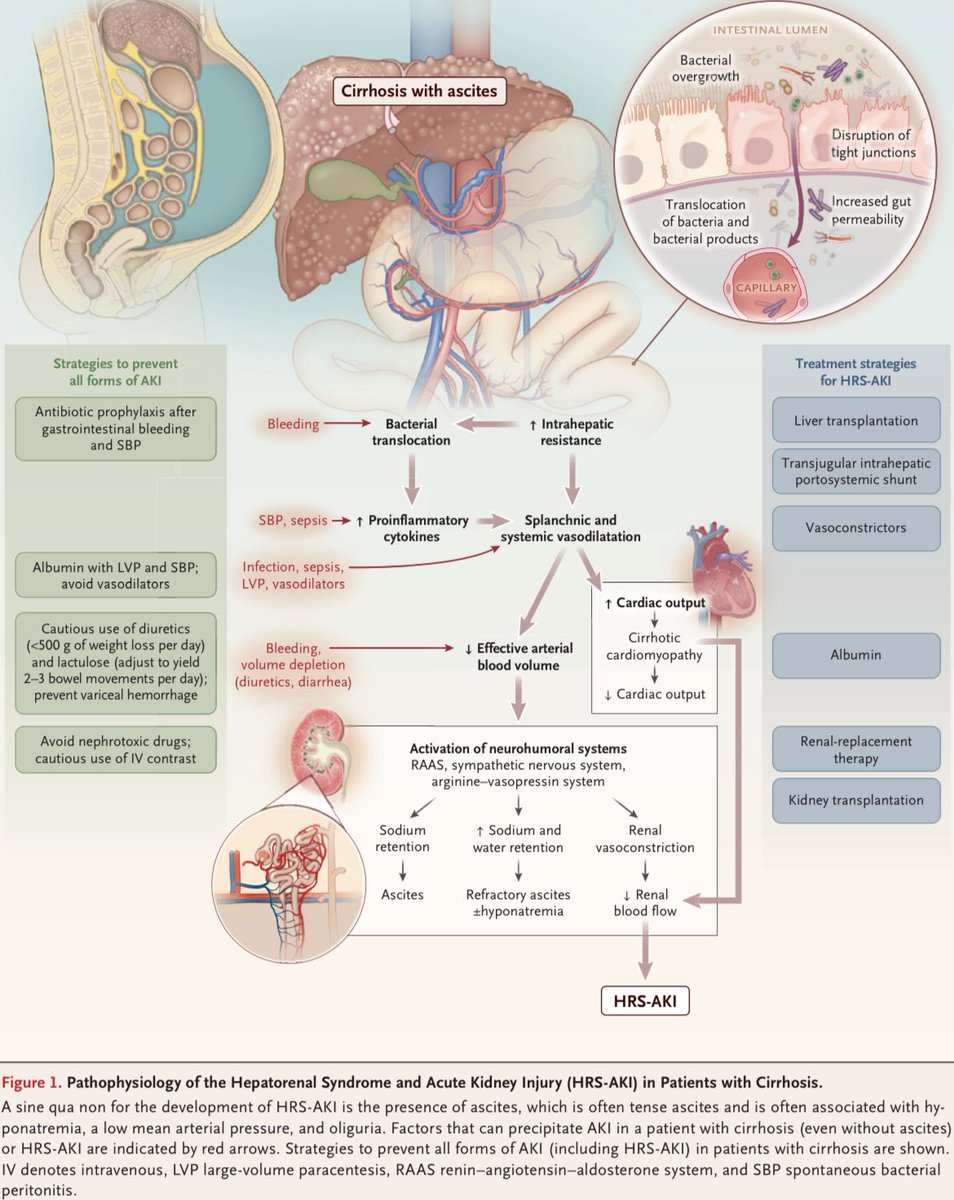 Fisiopatología del síndrome hepatorrenal y lesión renal aguda en pacientes con cirrosis: N Engl J Med 2023;388:733-45.