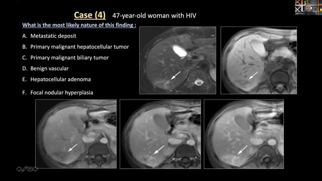 🔍🚀 Brace yourselves for another captivating challenge! 🌟 Introducing Case 4 of our intriguing case series! 🎉 Radiology enthusiasts, are you ready to put your diagnostic skills to the test once again? 🤔 Dive into this new case and see if you can crack the diagnosis! 💡…