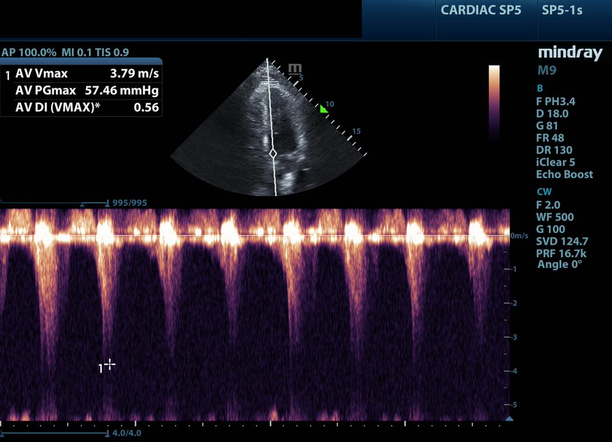 #1: Falling blood pressure with increasing doses of epinephrine... Consider dynamic LVOT obstruction - epinephrine and other inotropes will make the hypotension and stroke volume WORSE, not better. Screen with #POCUS - look for hyperdynamic LV, aliasing over the LVOT, a PW…