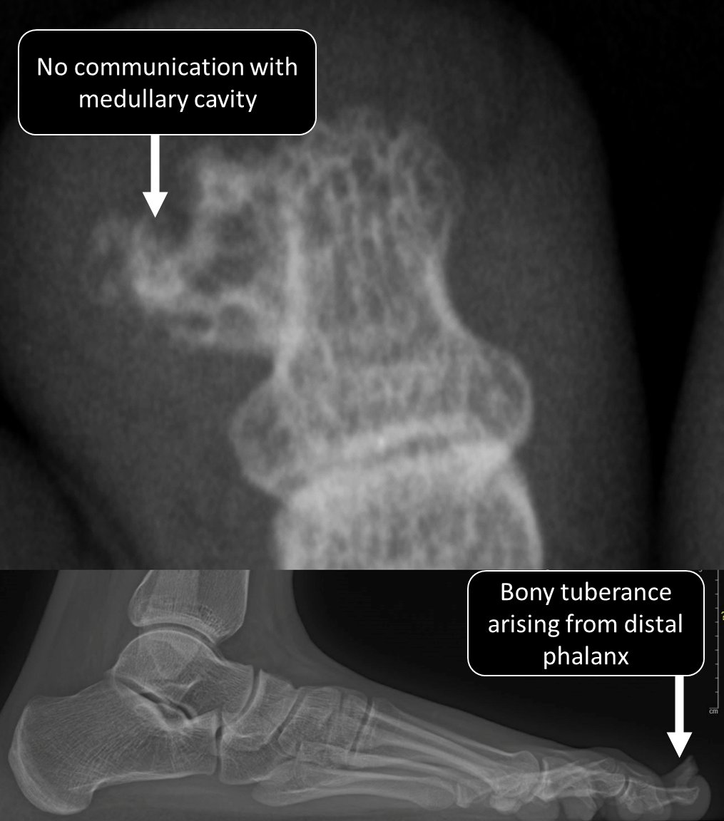 Something bony sticking out of the big toe, diagnosis?
A) Bizarre parosteal osteochondromatous proliferation
B) Subungual exostosis
C) Osteochondroma
#pedipath #bstpath #pathology #pathtwitter