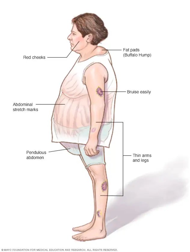 Which disease?🤔

#Usmle #DrSam👩🏼‍⚕️🩺 #medtwitter #match2024 #match2023 #ecfmg #ecfmgcertificate