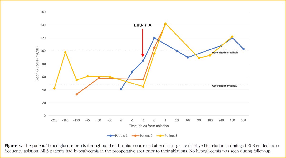 LumirKunovsky's tweet photo. 📈 Radiofrequency ablation for the management of #symptomatic #pancreatic insulinomas
🩸Patients’ blood #glucose trends in relation to timing of EUS-guided RFA
✅️ No hypoglycemia was seen during follow-up
📓 in @GIE_Journal
👉https://t.co/2uF8f4uEGP
@ASGEendoscopy https://t.co/WSImaUaABO