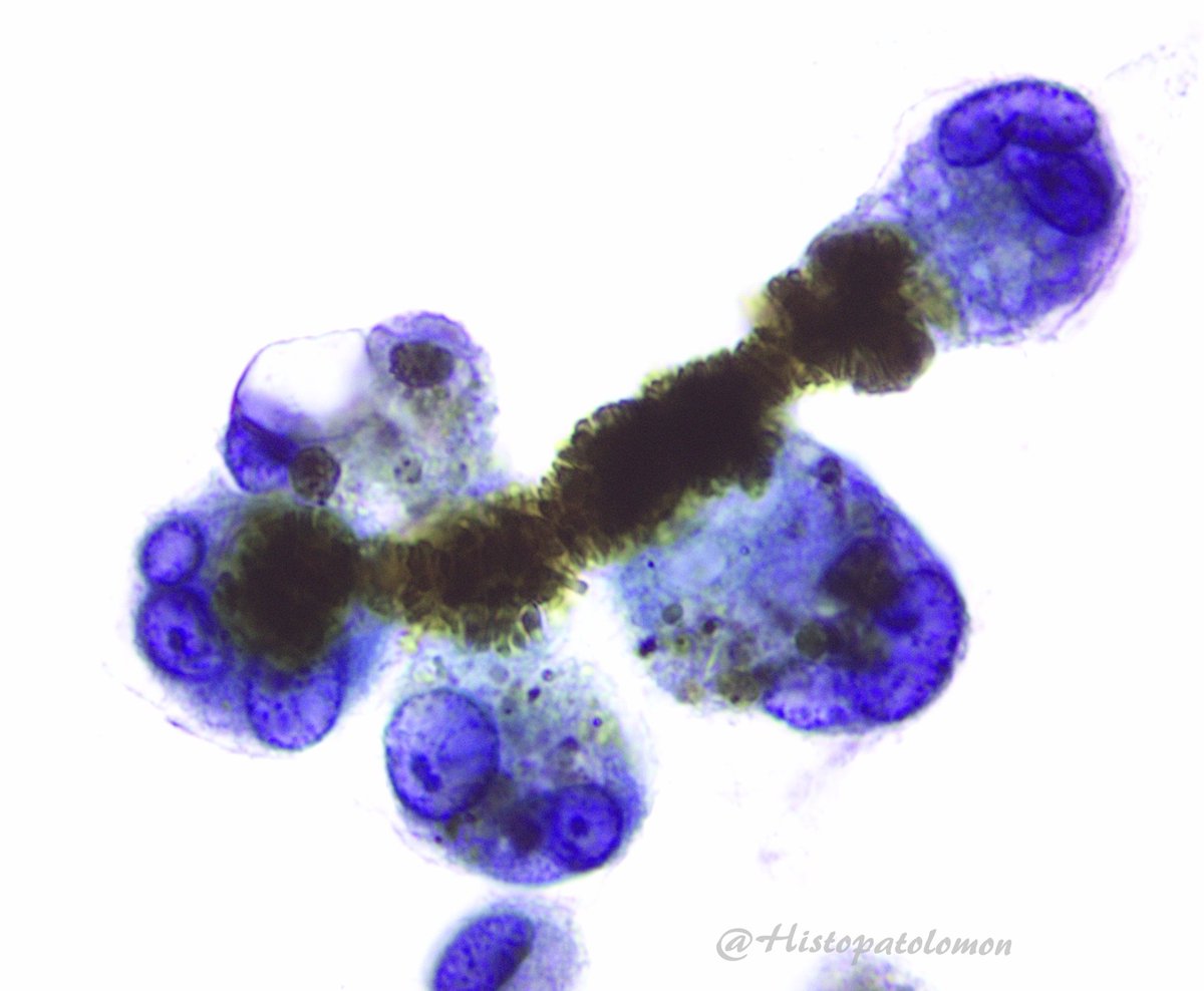 Hello Friends, I have the pleasure of sharing with you some of my best photos of ferruginous bodies. We do not see the fiber around which it has formed. There are multinucleated macrophages that have either formed it or try to phagocytize it #ferruginousbodies #ferruginous #BAL