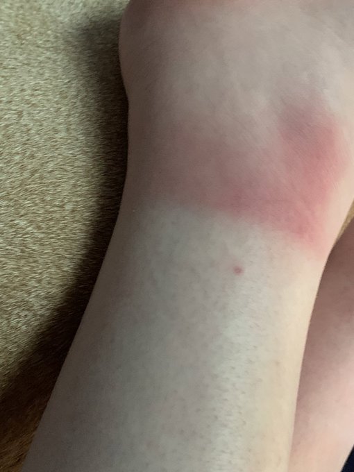 Kids this is my ankle after about 20 collective minutes of having it exposed during softball practice