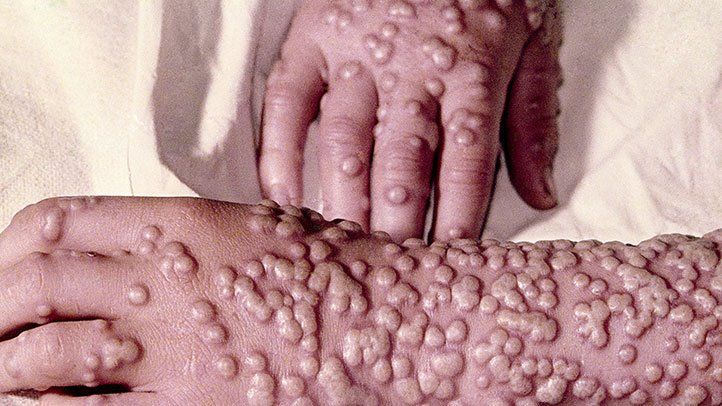 Is smallpox still a threat? The viral disease killed ~500M people in the 20th century & is the only human infectious disease to be eradicated. But a new report on the future of smallpox argues the US & the global community should prepare for a comeback medicalxpress.com/news/2024-04-s…