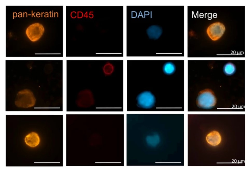 Using different in vitro NSCLC models, researchers showed that NSCLC cells with low #HERC5 expression had increased malignant and invasive properties. The @JournalofExper1 study comes from the University Medical Center Hamburg-Eppendorf's Wikman Lab: bit.ly/43YWyet