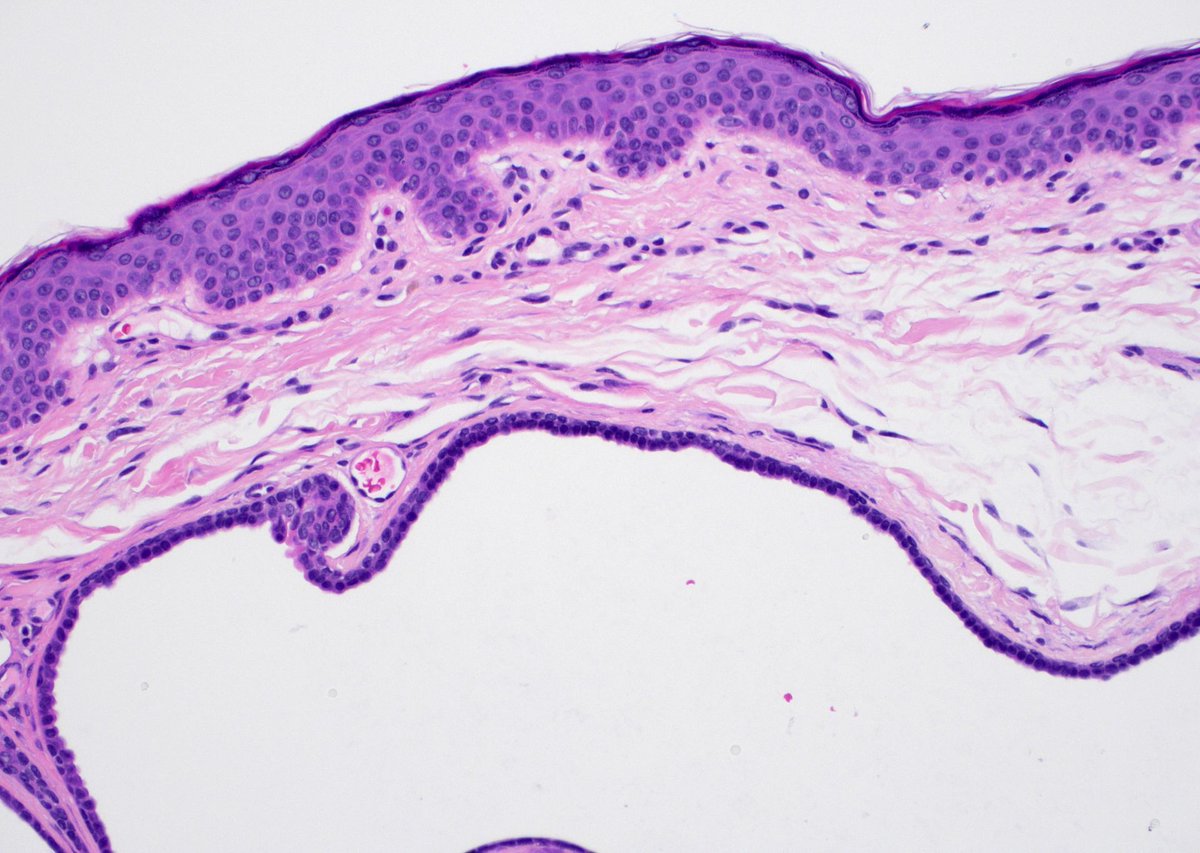 40 F. Cheek. Can you make diagnosis from one pic, or is it #TooCloseToDiagnose?
More pics: kikoxp.com/posts/18023
Answer & video: ✅ ⏯️  kikoxp.com/posts/4383 & kikoxp.com/posts/4394 
#pathology #pathologists #pathTwitter #dermpath #dermatology #dermatologia #dermtwitter