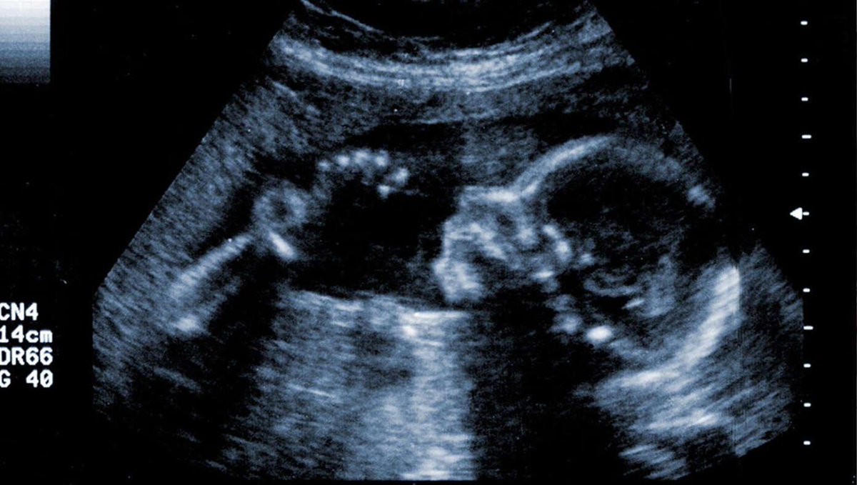 4D Chess: Baby About To Be Aborted Claims Squatter's Rights buff.ly/4cVpkRg