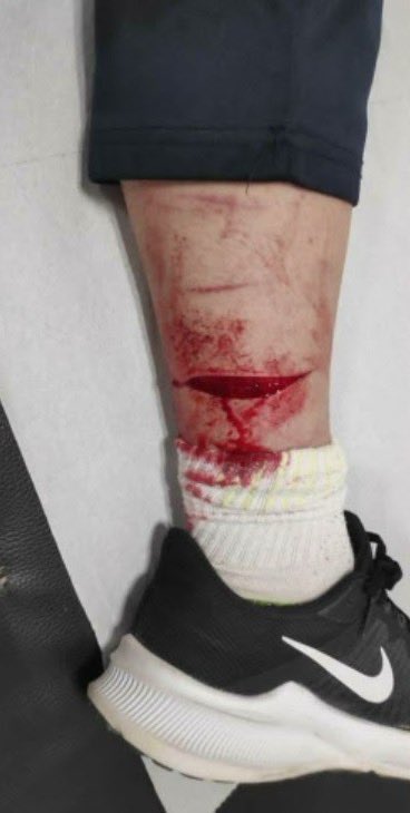 55kgsofii's tweet photo. foto de mala calidad que me hizo mi padre en el hospital
#shtwt #subtwt #selfharm #g0re #gor3 https://t.co/QtzoGIFc6O