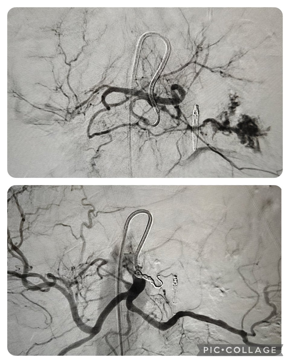 L gastric artery bleed embolised by coils with patients shocked after failed OGD. Now it's time for recording the new @_backtable episode on the Woundosome! @kmadass @keithppereira @DonGarbettMD @karananandpara @t_intheleadcoat @ADiamantop @Vascupedia_com @drcostantino1 @bahetimd