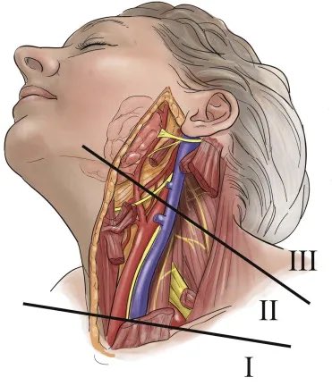 The neck trauma zones: Are they still valid? #SoMe4Surgery @juliomayol @PipeCabreraV @pferrada1 @SWexner