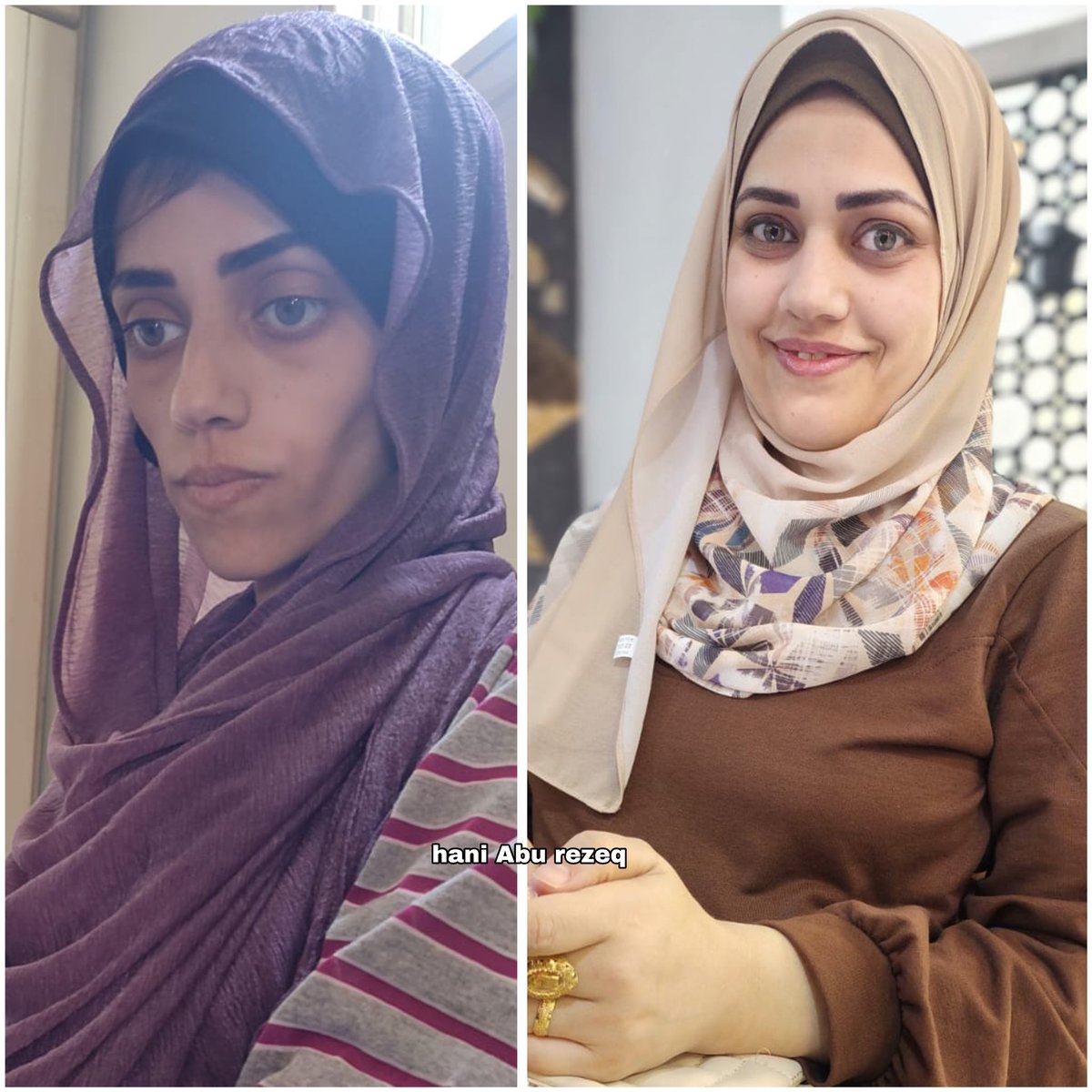 In the first picture, Anood appears as a mother of two, aged 29. She was diagnosed with stomach cancer a year ago, and due to lack of treatment, her condition deteriorated as seen in the picture on your left, making her look like she's 60 years old. To: +972 59-543-0411.'