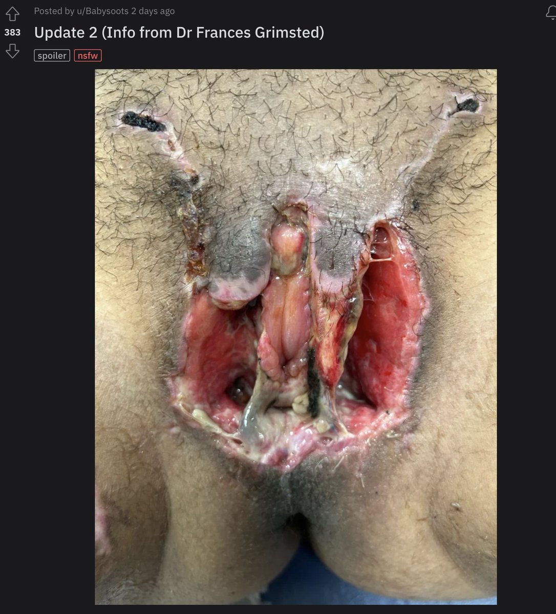 Graphic: An American account on the 'Transgender_Surgeries' subreddit has posted a graphic testimony and photo of complications resulting from bottom surgery. 'The yellow bits are discharge...and the black bit near the vagina is indeed necrotic tissue,' wrote the person. 'It will…