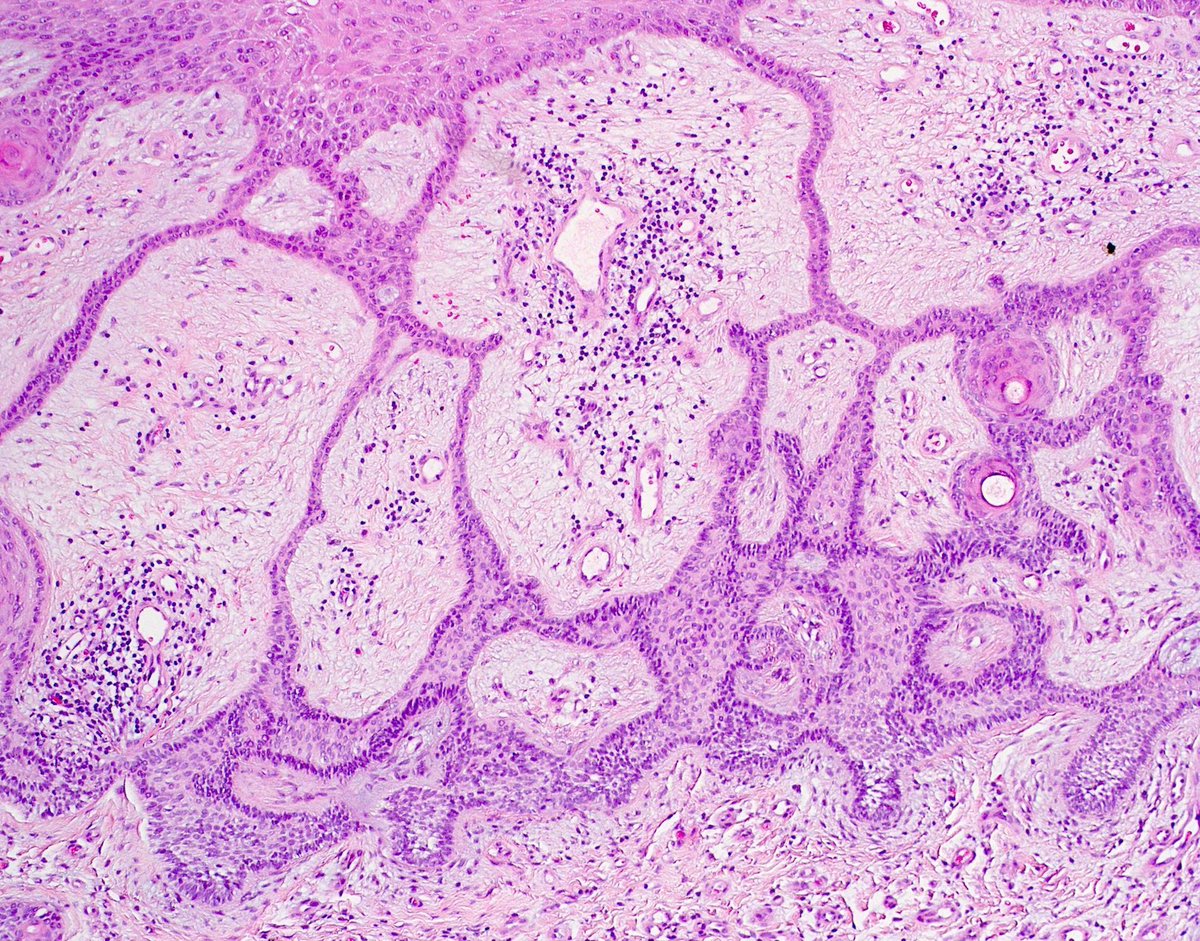60 M. Red plaque on lower back. Diagnosis?
More pics: kikoxp.com/posts/8178 
Answer: kikoxp.com/posts/11637
Another case: kikoxp.com/posts/14392
Video: kikoxp.com/posts/14144 
#pathology #pathologists #pathTwitter #dermpath #dermatology #dermatologia #dermtwitter