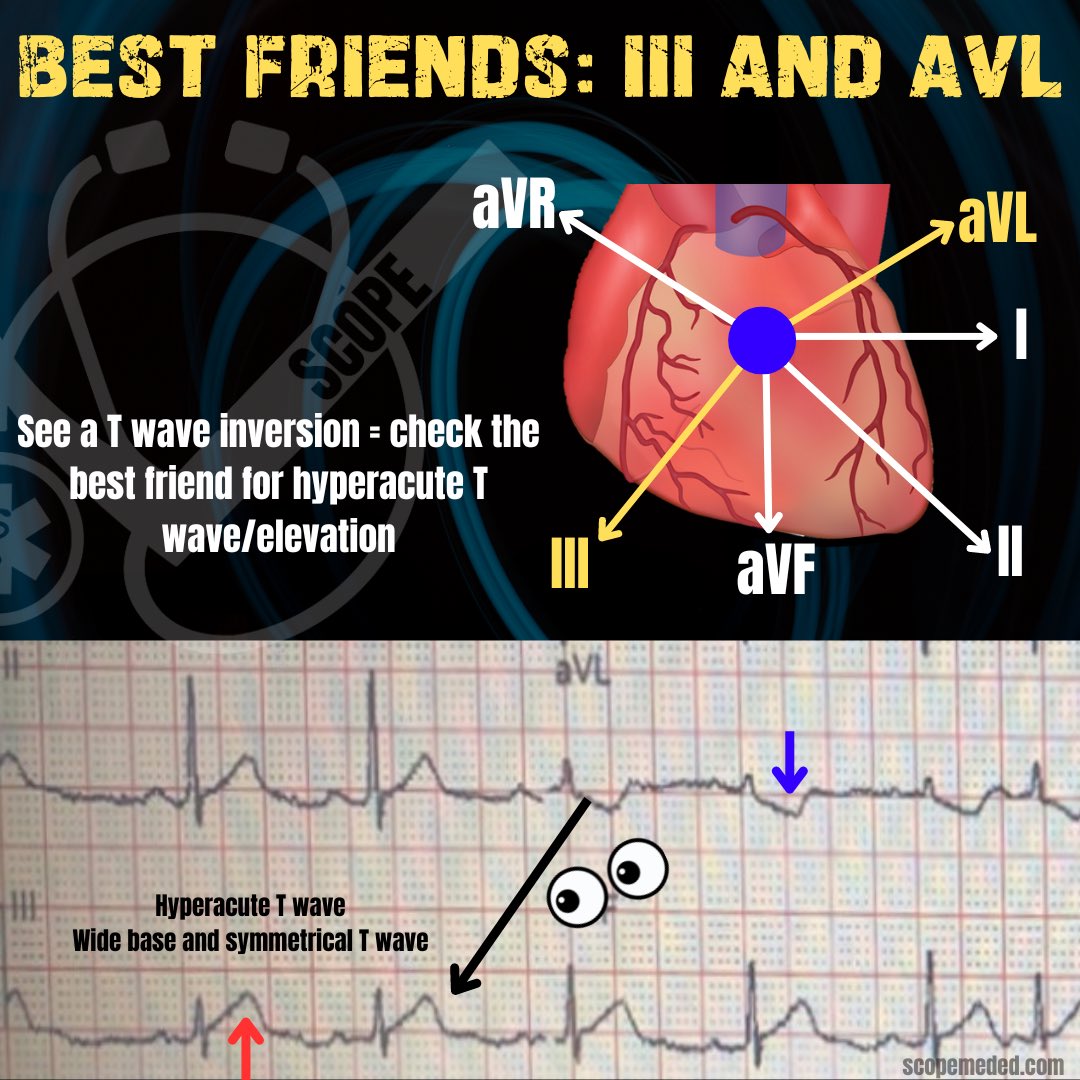 scopeducation's tweet photo. Lead III and aVL are best friends when it comes to their reciprocalness. They are nearly 180 degrees from each other. I like to see them as best friends because when there is an issue in one of them, I immediately look to the other for reciprocal changes.
#FOAMed #ecg #CardioEd https://t.co/S1qTYTsYVx