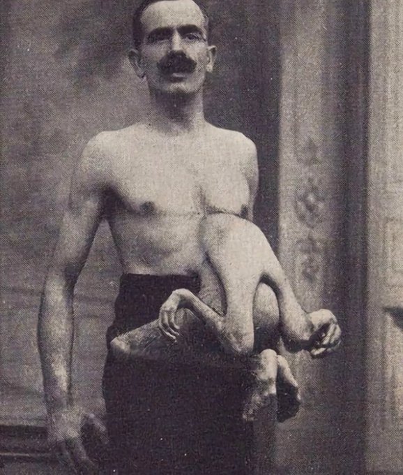 Jean Libbera, aka 'The Double-Bodied Man,' had his parasitic brother, Jacques Libbera, connected to him from his chest-stomach area.