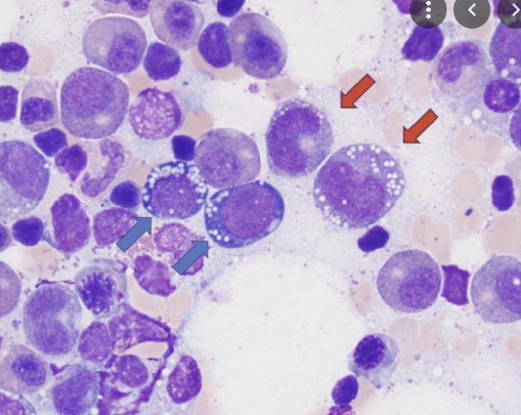 Copper Deficiency Anemia! Rare but seen in: TPN Postbariatric surgery Celiac dz Excessive zinc intake Menkes disease Anemia+neutropenia (thrombocytopenia rare) Variable MCV Mimic of MDS as dysplasia can be seen in marrow Cytoplasmic vacuolization erythroid/myeloid precursors