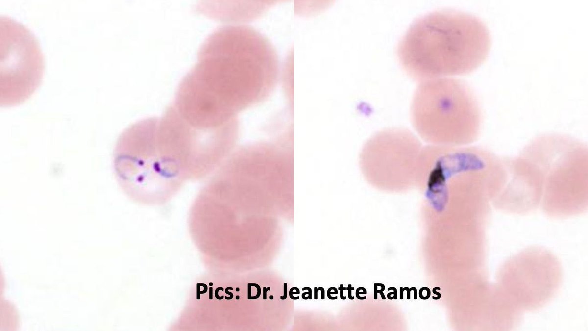 Peripheral blood smear. Your diagnosis? Answer: kikoxp.com/posts/5038. Pics by Dr. Jeanette Ramos @HemepathUAMS. #pathologists #pathology #pathTwitter #microbiology #parasitology #hemepath #hematology #medtwitter #usmle