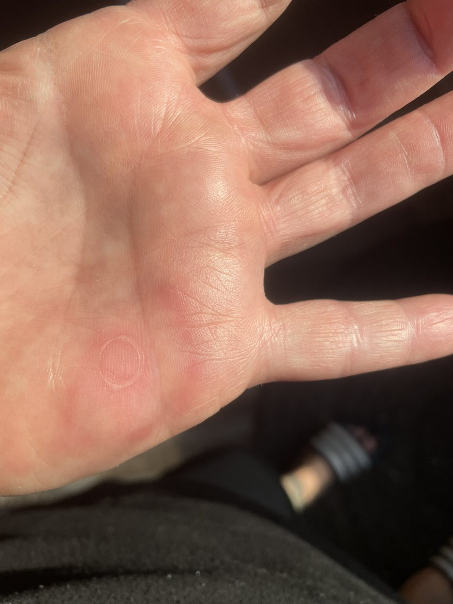 I see your line burn and I raise you a hexagon shaped burn on my hand from repairing the gas powerwasher.