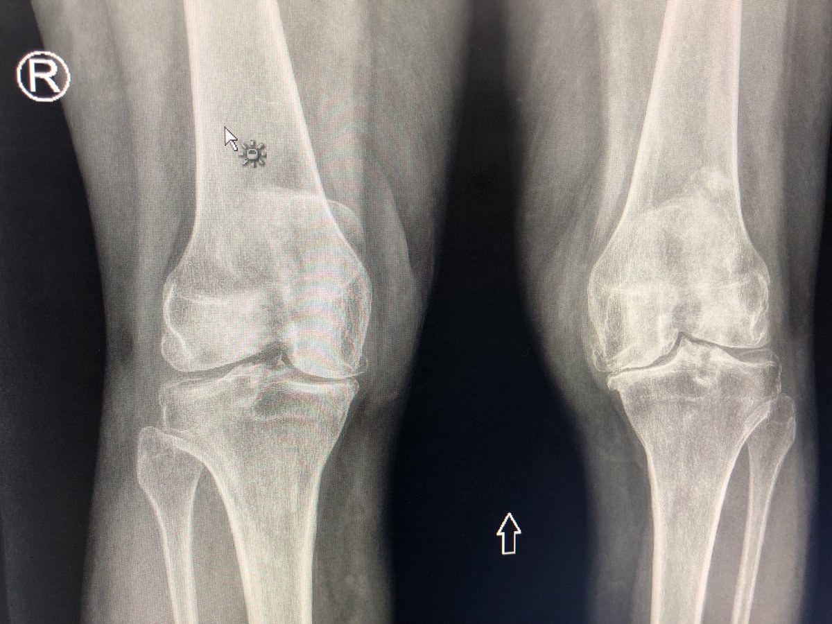 Janetbirdope's tweet photo. #ClinicalPearl
Order AP knees standing
To see actual #JSN #joint #space #narrowing
You know this view as you see ⬆️
What is the #diagnosis?
#Dx in 1 X-ray
#MedEd #MedX #Radiology #RheumEd #RheumX https://t.co/cFbctReYdV