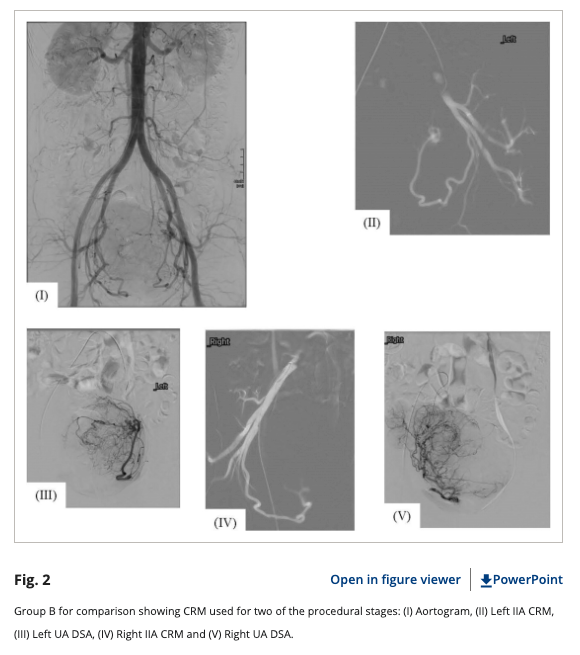 Another example of DSA runs for Uterine Artery Embolization (UAE) from our recent #openaccess article on radiation dose and minimisation for this procedure: