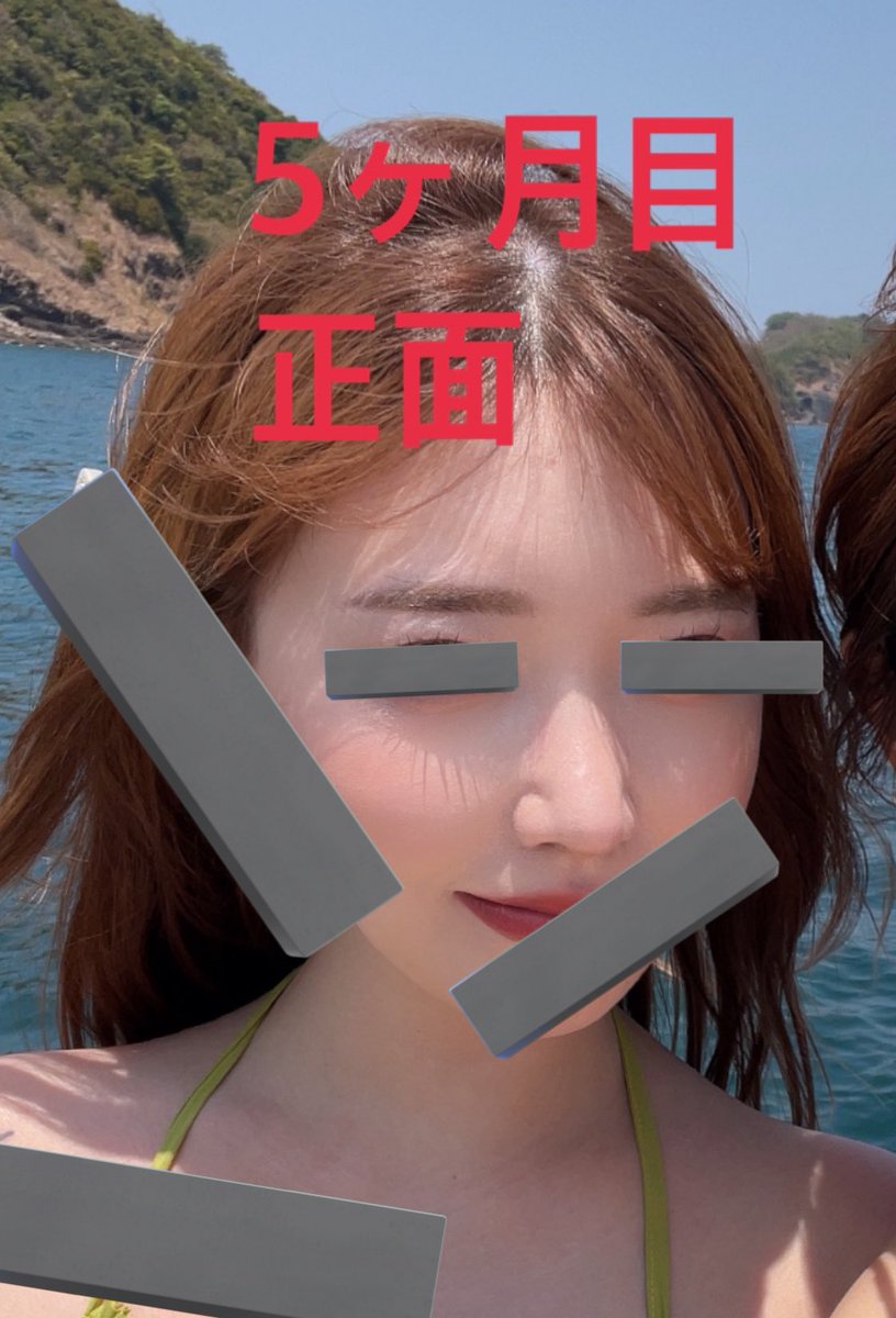 pi_ping0's tweet photo. ねえほんとやばい
みんな安心してくれ
鼻フルDT6ヶ月はガチ🥹❣️

数人に鼻先高すぎない？て言われてたけど、全員にナチュラルになったって言われて自覚した❣️

初手術で豚鼻からここまで変化出せてる人いる？後戻りも考えて肋軟骨にしてよかった😭

#鼻フル #DT #韓国 https://t.co/J7aeUNWoVI