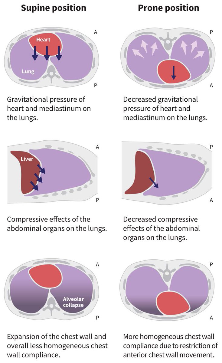 A comparison of some physiological effects of supine (left) and prone (right) positioning.
#FOAMed #FOAMcc #CriticalCare 
🔗cmaj.ca/content/192/47…