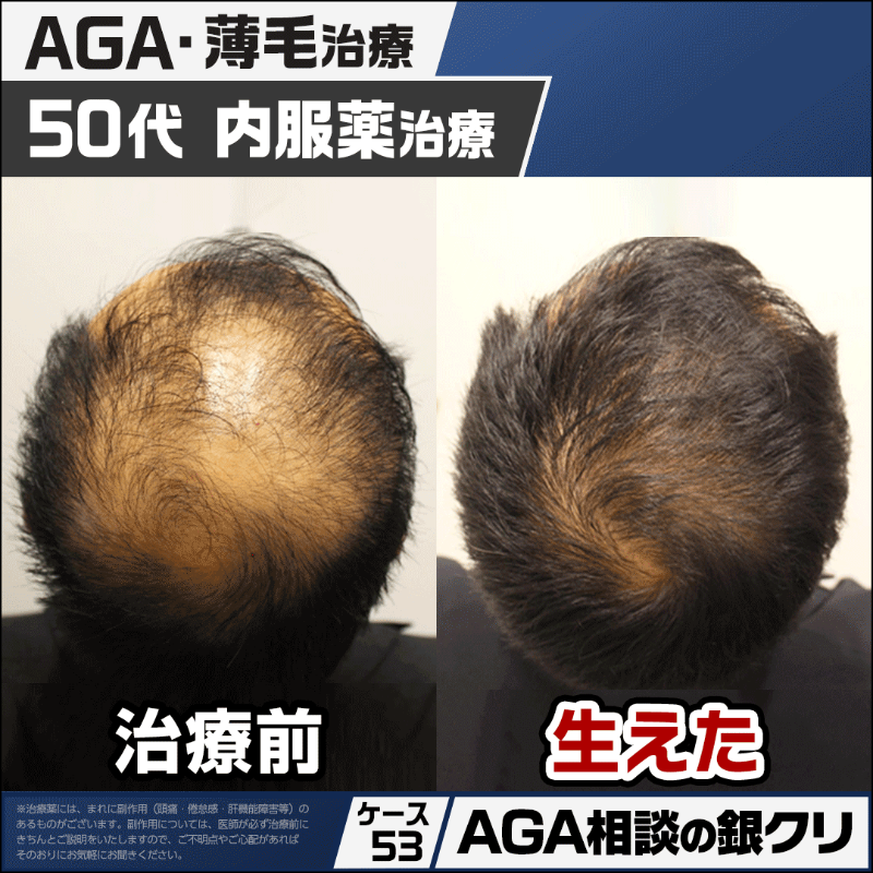 gincli_aga's tweet photo. 185万人のAGA治療実績！初診料＋カウンセリング＋進行予防薬（フィナ）＋発毛治療薬（ミノキ） これら4つ全てで1日33円からAGA治療をスタート。

通院不要のオンライン診療もOK。もちろん対面でしっかり医師に診てもらう事も可能です。AGA治療専門クリニックで半年後にはしっかり生えた髪を目指そう！