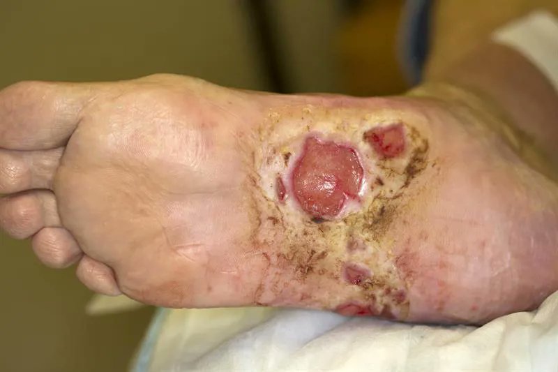 FavMedic's tweet photo. I see a lot of diabetic patients everyday with bad foot ulcers. Some eventually get amputated.  It breaks my heart knowing some of them could have been avoided .

If you are diabetic or maybe your parents are, you should read this thread. 👇 https://t.co/WZpHhsXrUU