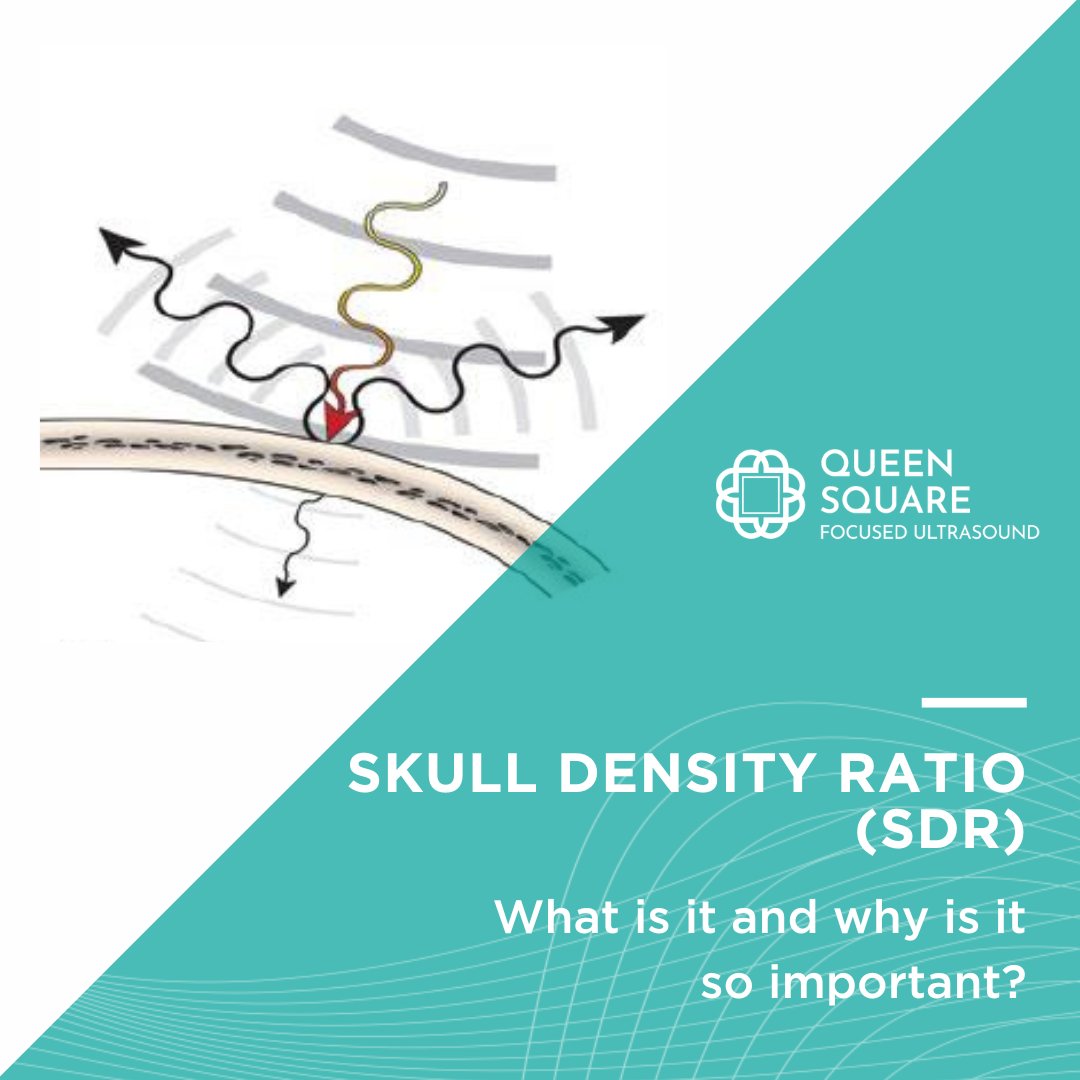 A key part of the assessment of patients prior to #MRgFUS for #Tremor is a #CTscan of the skull, which is used to calculate an important factor called the SDR. But what is SDR and why is it so important? Our article explains:

🔗 - eu1.hubs.ly/H08Bcrt0 
 
@NatTremor