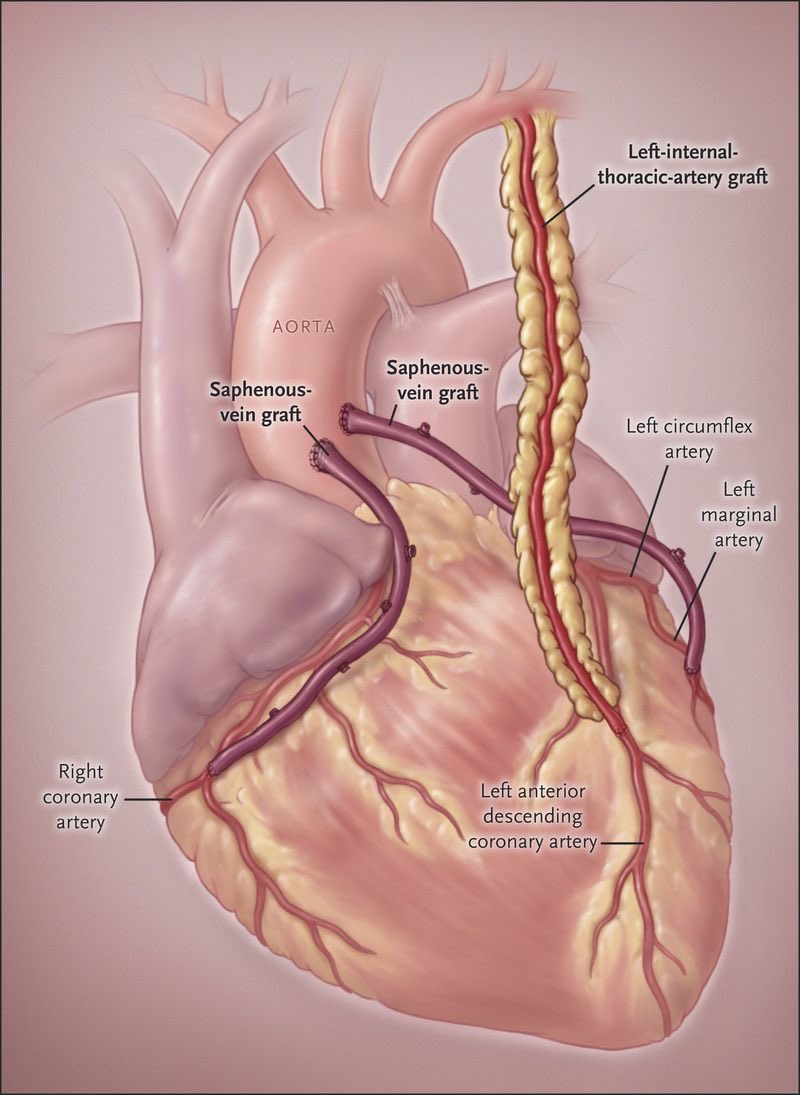 Options for CABG coronary artery bypass graft