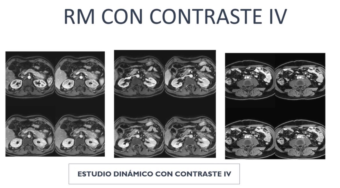 sediabdomen's tweet photo. Has visto ya el nuevo #casosedia del mes de Abril?
Puedes verlo en https://t.co/BONPVBN3fF y si sabes la respuesta envíala a info@sedia.es. Puedes ganar una inscripción para el proximo #congresosedia https://t.co/iriaZLnPPC